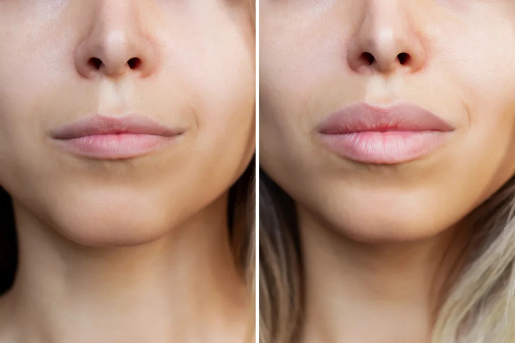 Result of lip augmentation Cropped shot of young blonde woman's lips; lip service Augmentation, Lifts, Fillers, And More