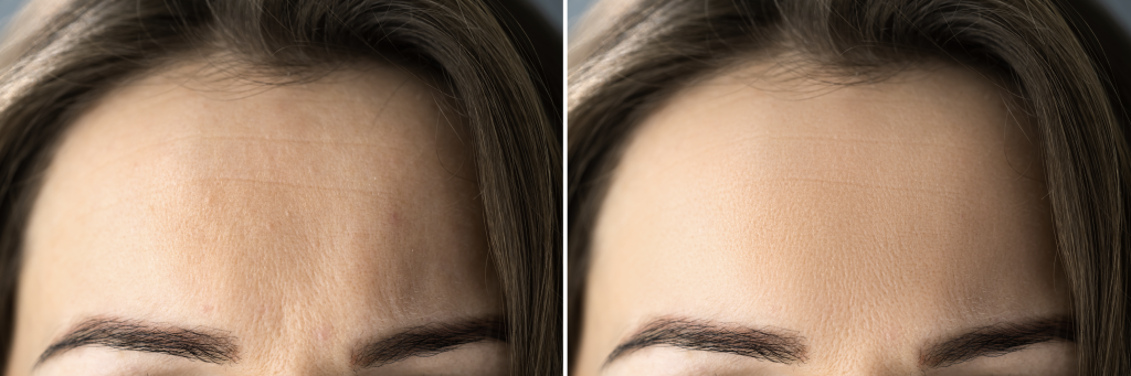 focus on
foreheads
Surgical & Non-Surgical Procedures
By Annette Brooks